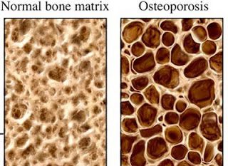 HOW TO STOP OSTEOPOROSIS