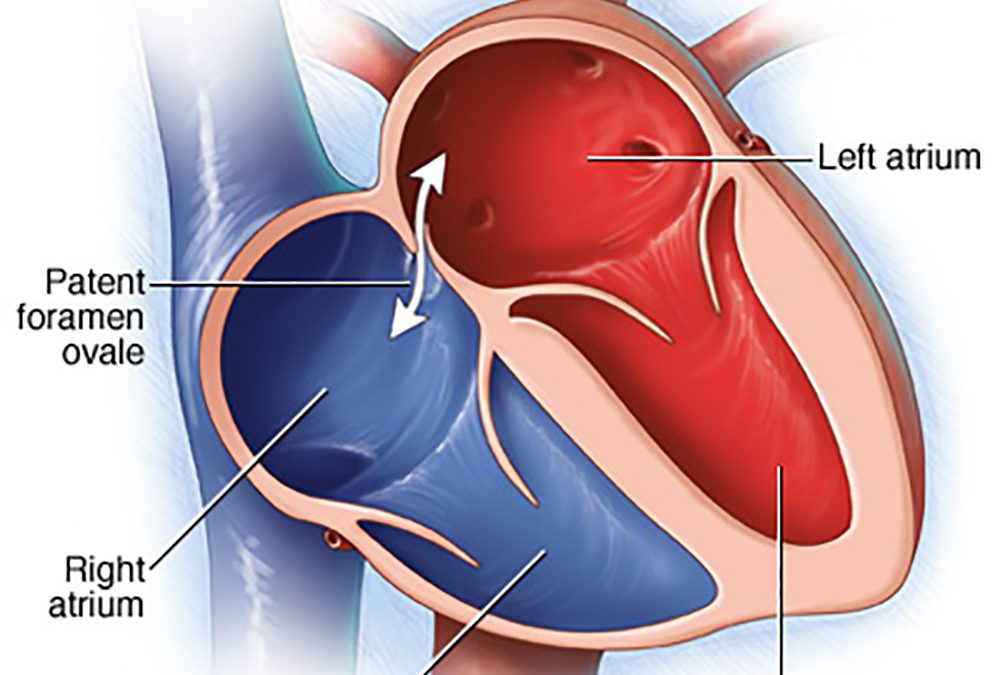 40% HAVE A PFO (PATENT FORAMEN OVALE) – DO YOU?