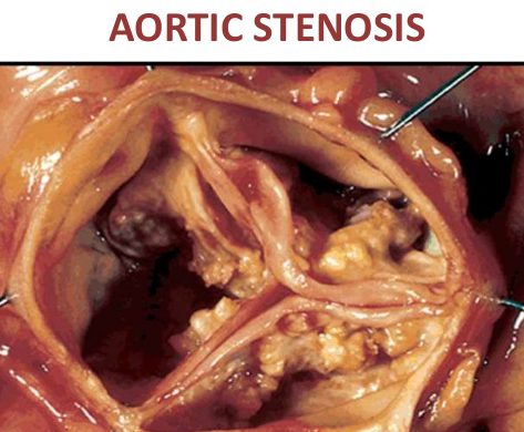 CIRCADIAN RHYTHM DICTATES AFTERNOON HEART SURGERY FOR AORTIC VALVE