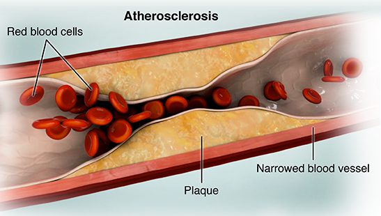 INFLAMMATION NOT LDL